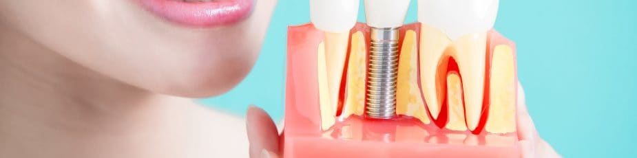 bridges, implants, or dentures for replacing missing teeth