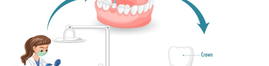 when to get dental crowns: a comprehensive guide