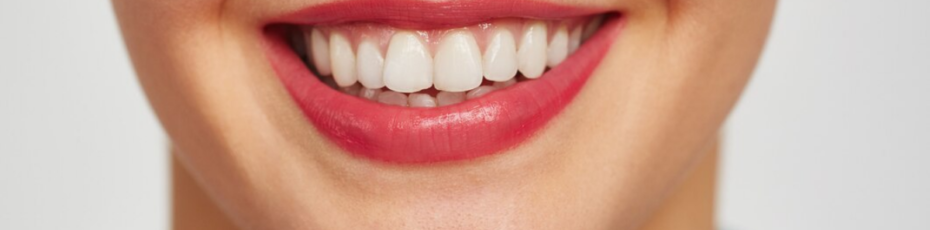 teeth whitening vs. veneers: which option is best for your smile?