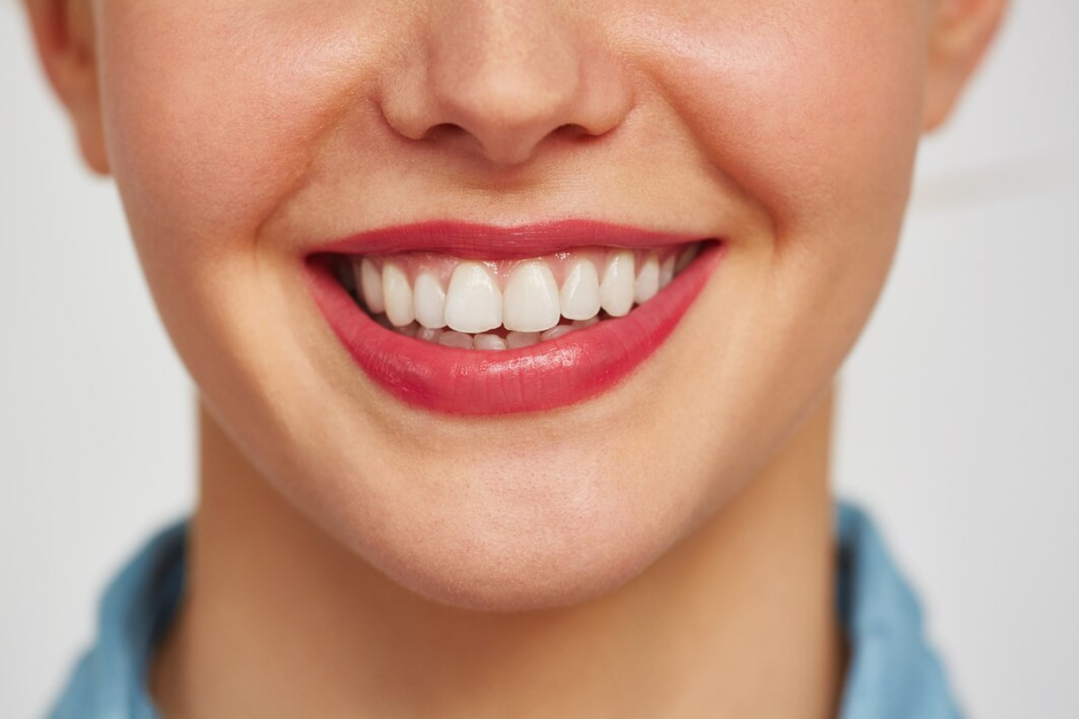 teeth whitening vs. veneers: which option is best for your smile?