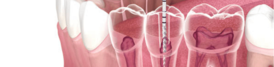 essential tips for smooth and fast healing after getting root canal therapy