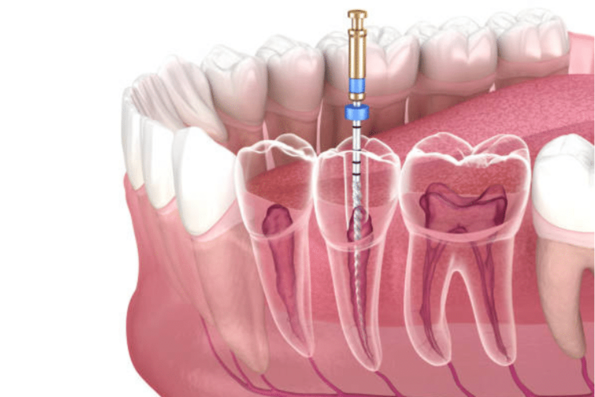 essential tips for smooth and fast healing after getting root canal therapy